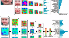 面部识别和人工智能可用于识别罕见遗传病