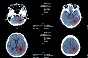 Nature Medicine:新人工智能算法有助于检测脑瘤